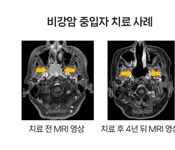 [월간암] 짧은 기간 중입자치료로 두경부암 환자 종양 소멸 확인